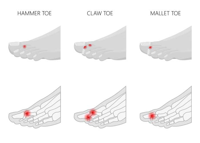 What Does a Hammer Toe Look Like & What Causes It?