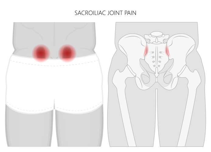 SI Joint Pain