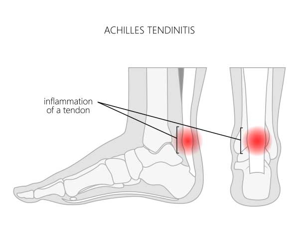 Achilles Tendonitis