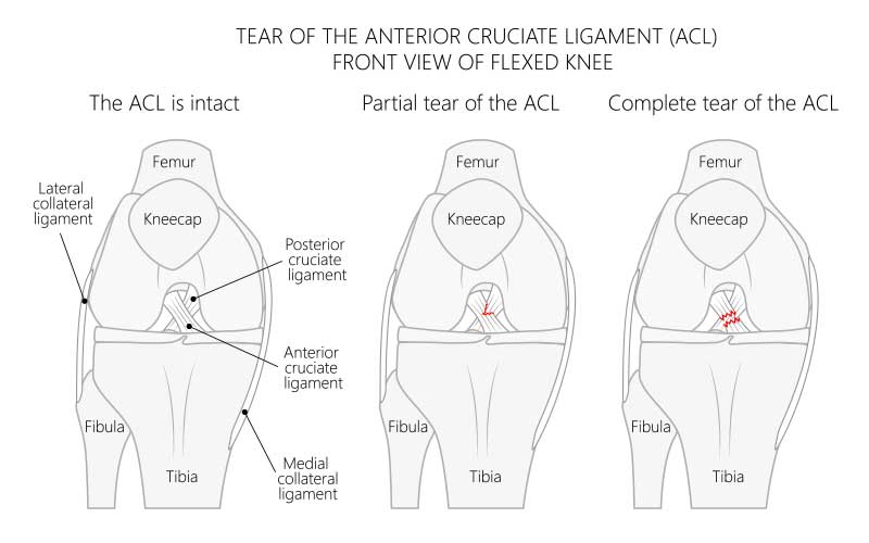 ACL and PCL Tear Anterior