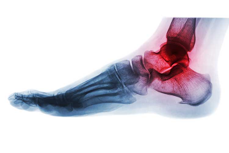 Ankle Osteoarthritis