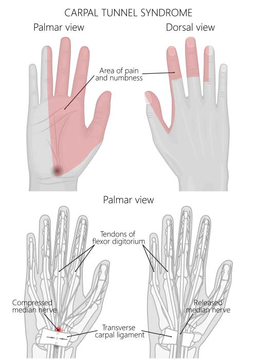 wrist bursitis