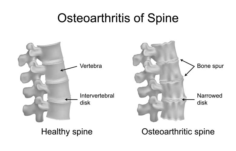 facet arthropathy