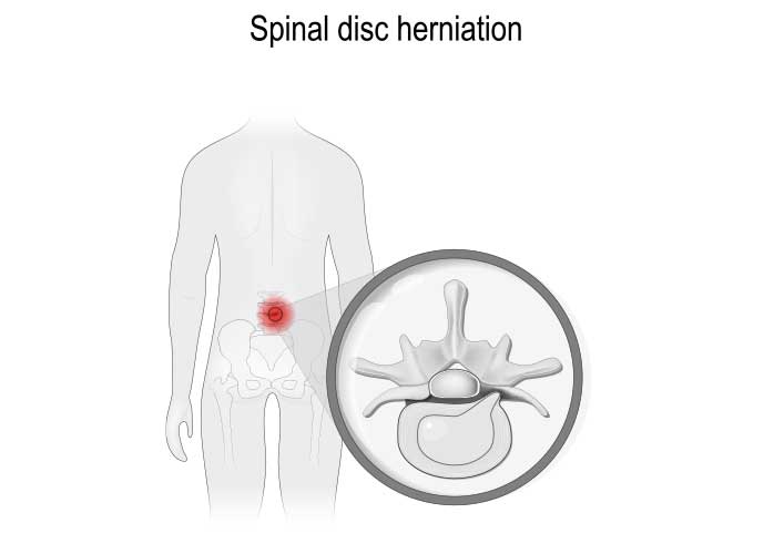 Back Flex Lumbar Brace  BioSkin Bracing Solutions