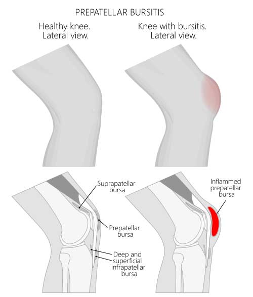 Knee Bursitis