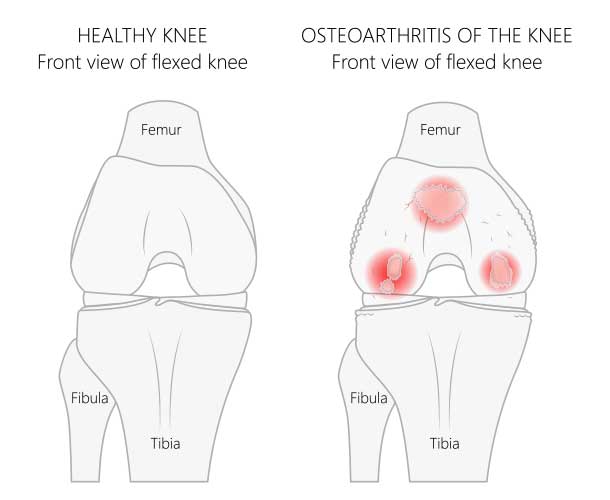 Knee Osteoarthritis