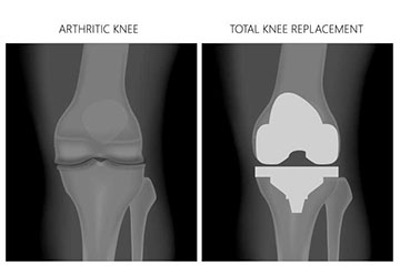 Post-Operative Knee Surgery    
