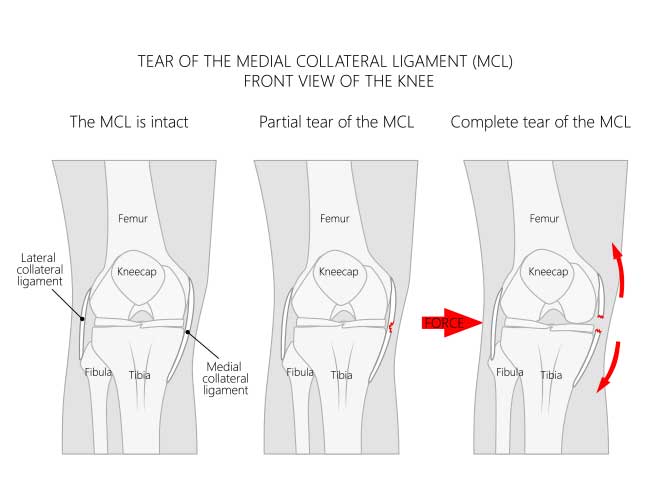 mcl_lcl_tear_medial