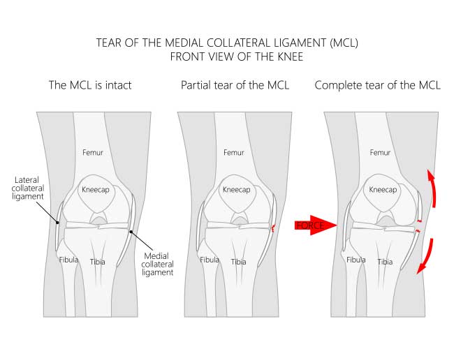 MCL and LCL Ligament Injury Solutions BioSkin Innovative Bracing