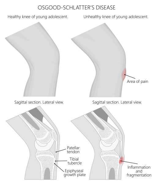 Growing pains deals in knee