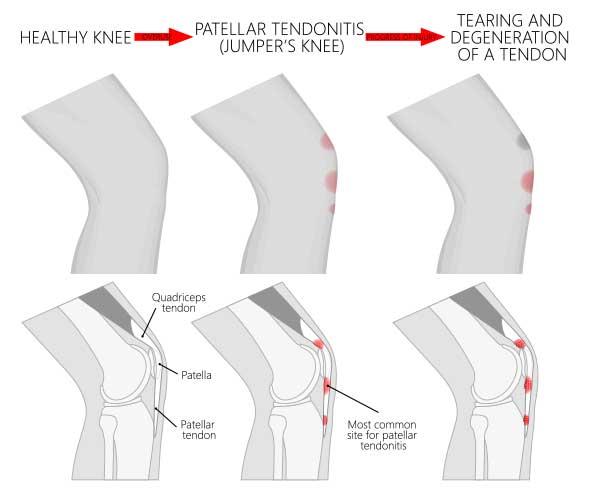 Patellar Tendonitis (Jumper's Knee)