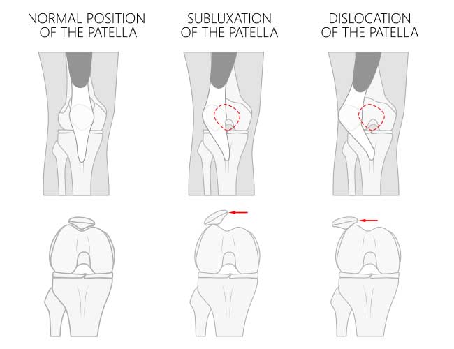 Patella Tracking Disorders