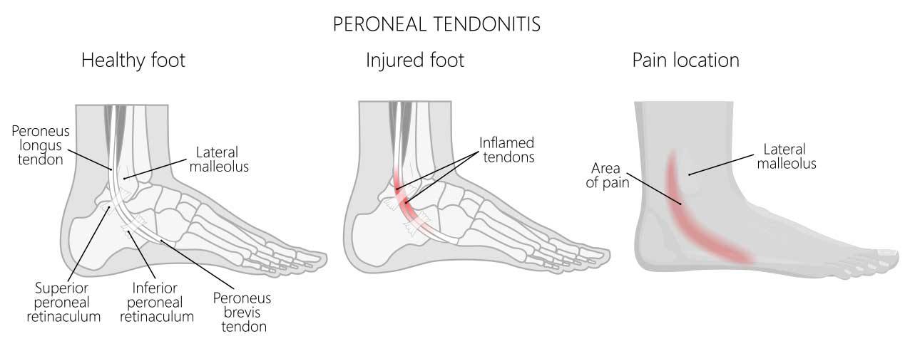 Peroneal tendonitis