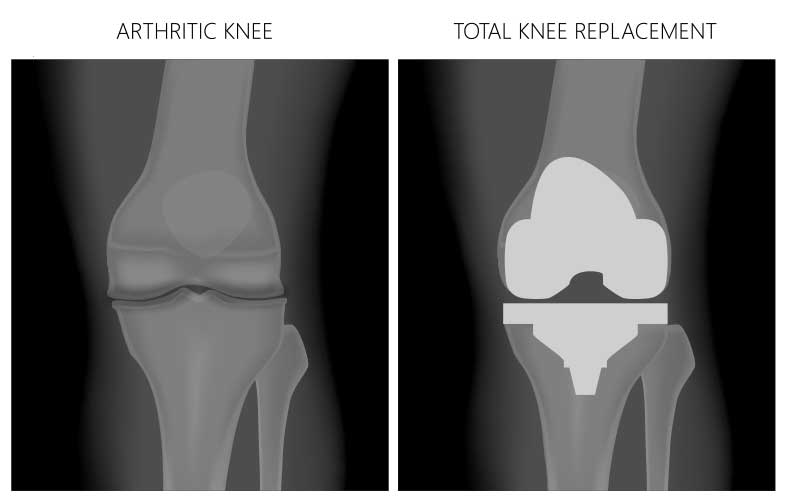 Post-Knee Surgery