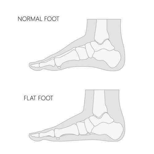 PTTD, Post-Tib Tendonitis, or Flat Foot Treatment | BioSkin Bracing