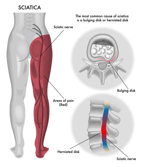 Conditions  Best Back Pain, Slip Disc, Knee Arthritis, Sciatica