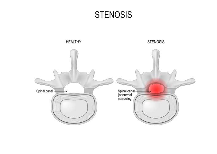 Spinal Stenosis