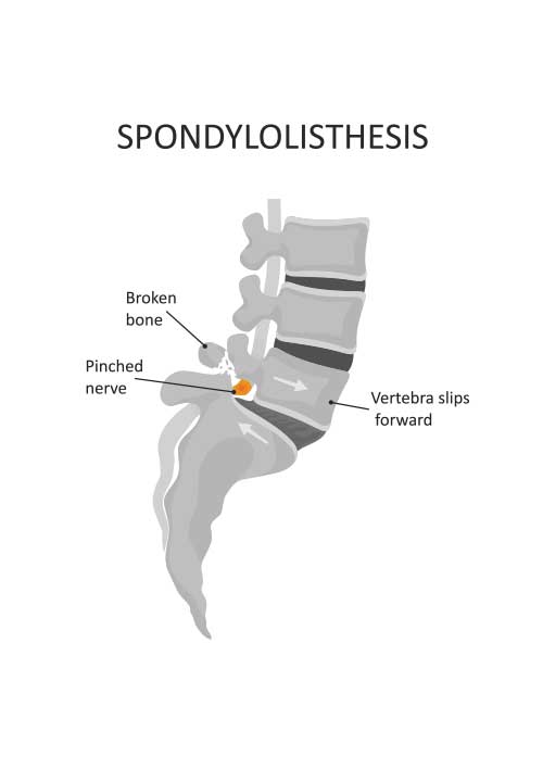 Spondylolisthesis back outlet brace