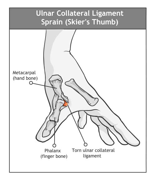 Thumb Sprain / Skier’s Thumb