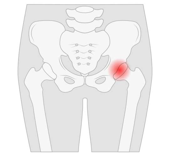 Ischiocapsular Sprain